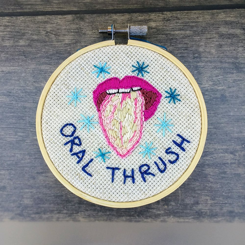 Oral Thrush