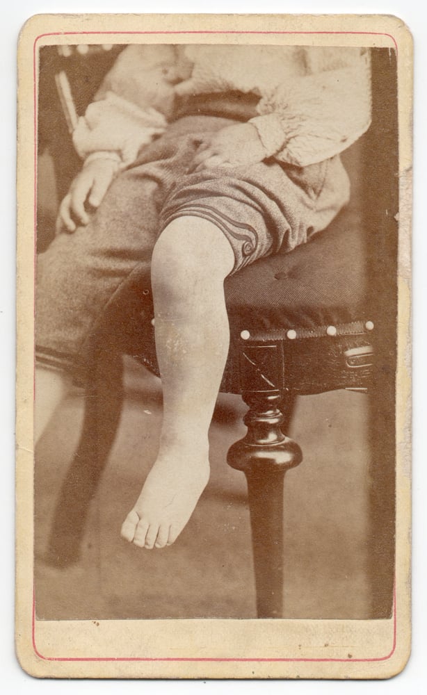 Image of Davis & Severn: a kid's leg, Chicago ca. 1865