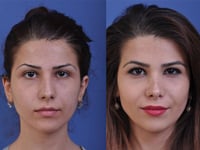 The Ultimate Guide to Rhinoplasty in Turkey: What to Know Before You Go