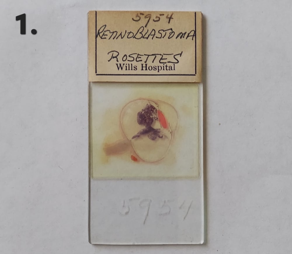 Vintage Medical Slides – Human Eye (Retinoblastimo)