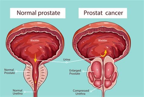 PROS-TATE! Prostate-Blood Pressure-Blood Sugar-Detoxer-Hair Loss-Eczema-Osteoarthrits  