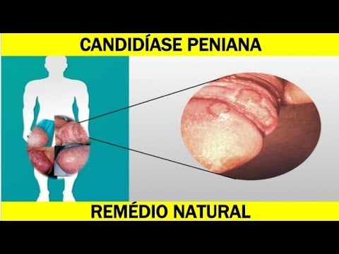 PINK TRUMPET! Pau d'Arco Adaptogen. Food/Beverage Additive. Candida/Yeast-Chemo-Cancer-Ulcers-Herpes