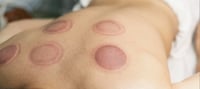 Image 2 of Fire Cupping Massge