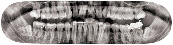 Image of X-Ray Deck