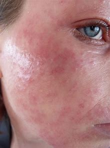 TamaNUskin! Luxurious Moisturizing Exotic Tamanu Nut Seed Body Butter. Eczema. Renews Skin Cells.