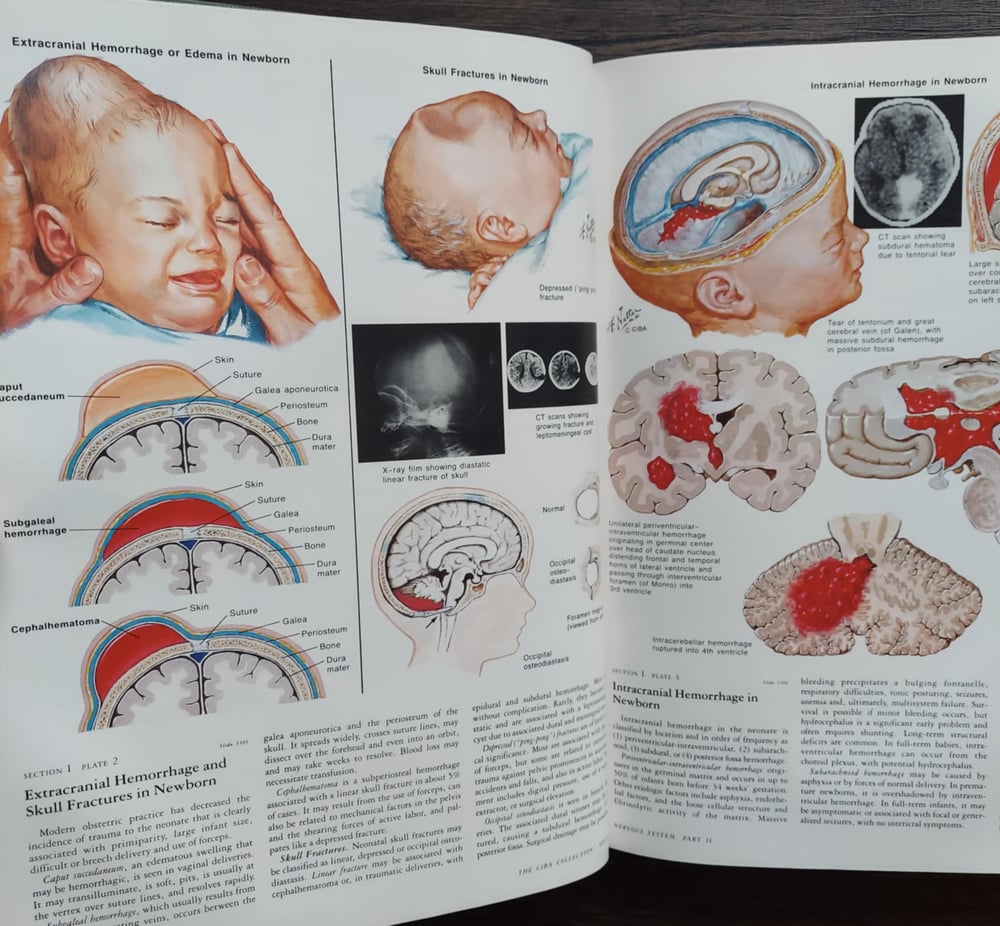 The CIBA Collection of Medical Illustrations: Volume 1 – Nervous System Part 2 – Neurologic...