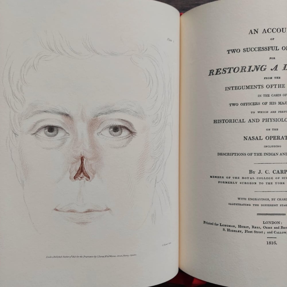 Restoring a Lost Nose, by J. C. Carpue