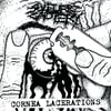 Sulfuric Cautery - Cornea Lacerations 7"