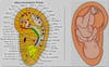 Ear Accupuncture (Auriculo Therapy)