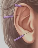 Ear Accupuncture (Auriculo Therapy)