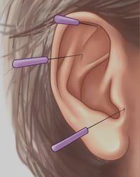 Image 3 of Ear Accupuncture (Auriculo Therapy)