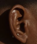 Ear Accupuncture (Auriculo Therapy)