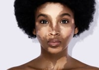 Vitiligo Awarness