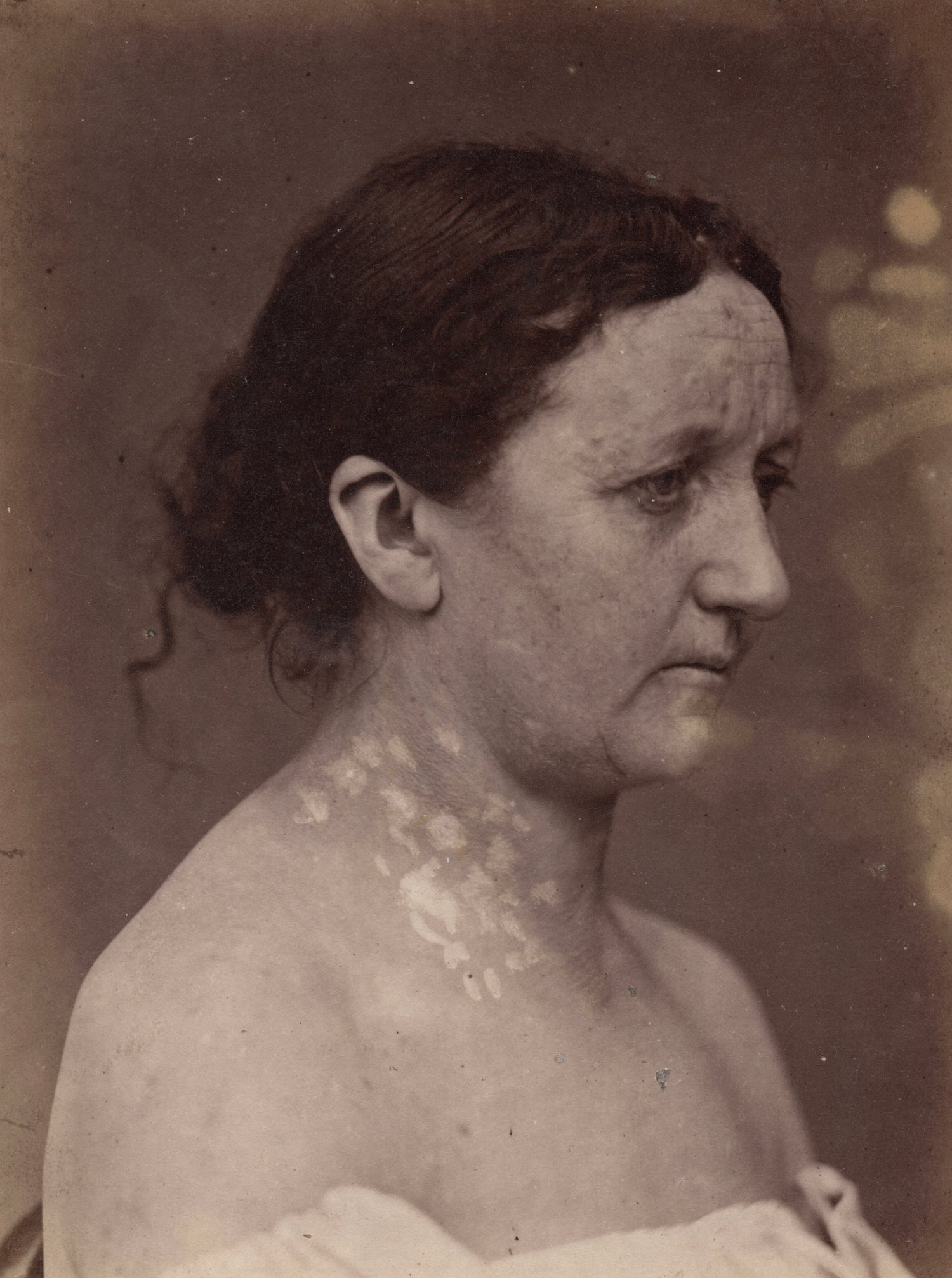 Image of A. de Montmeja: portrait of woman with Syphilide, ca. 1870