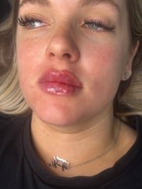 Lip filler 