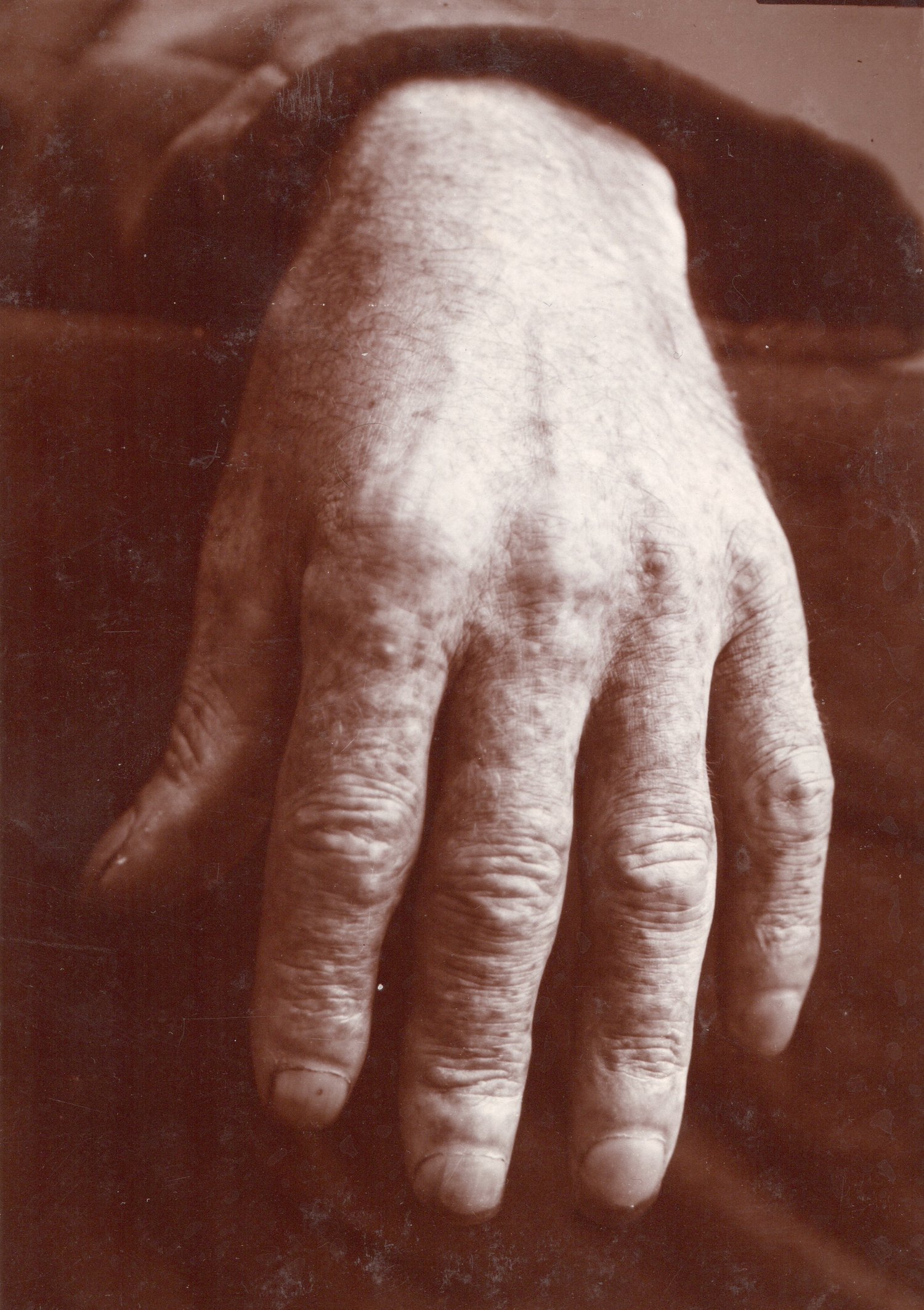 Image of Anonyme: hand with dermatitis, France ca. 1908