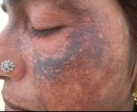 Image 5 of “OMEGA” MALASMA, POST INFLAMMATORY HYPERPIGMENTATION, DARK SPOT POTENT SKIN CORRECTOR 