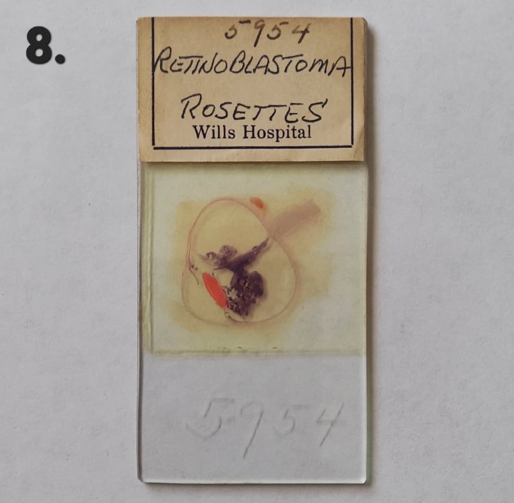 Vintage Medical Slides – Human Eye (Retinoblastimo)