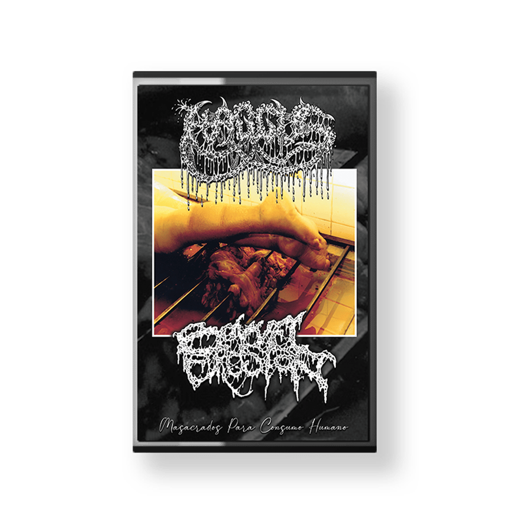 Bowel Erosion Split Tape
