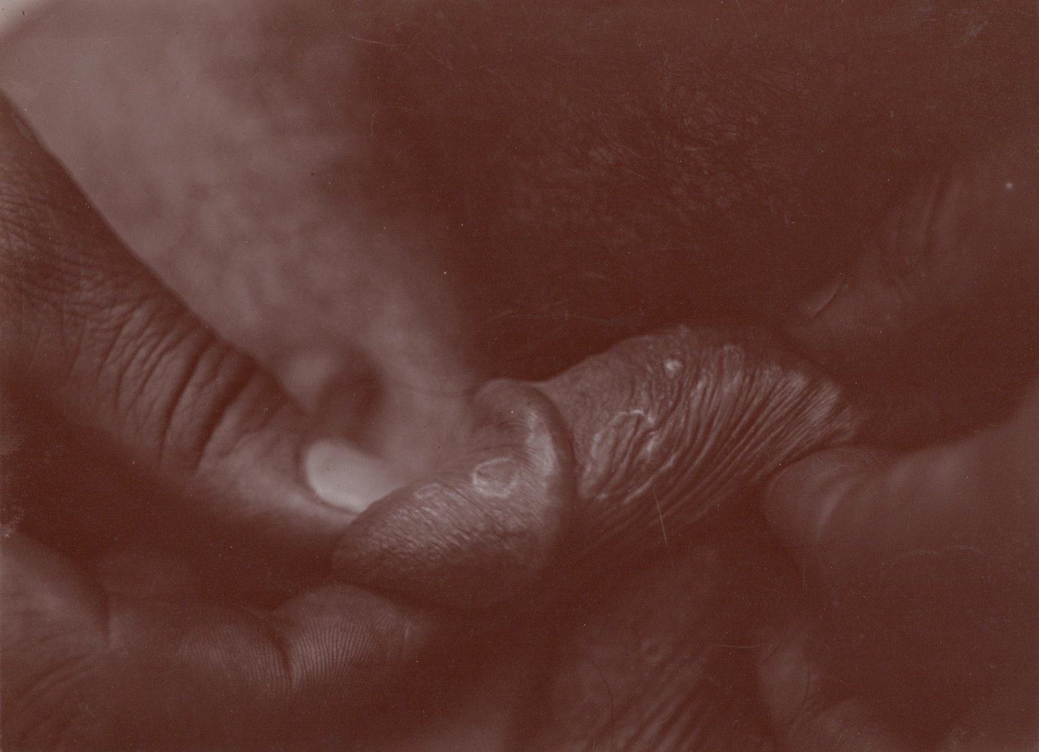 Image of Unknown: skin disease, ca. 1913