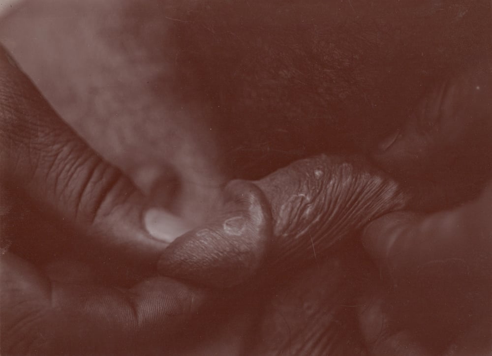 Image of Unknown: skin disease, ca. 1913