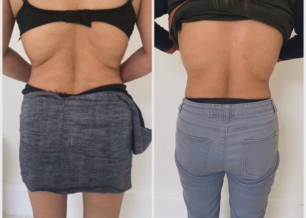 Image of Lemon Bottle Weight Loss Injections