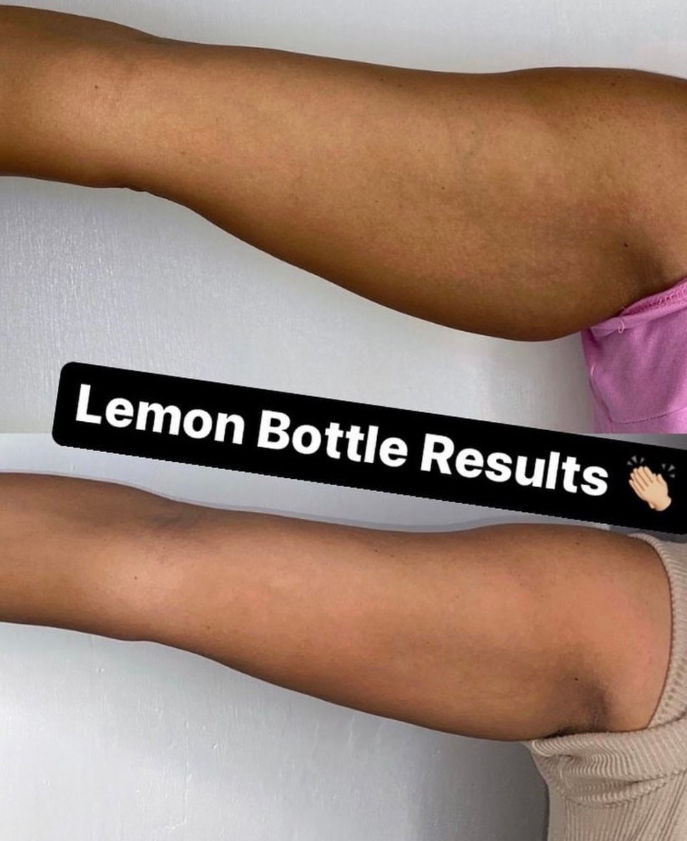 Image of Lemon Bottle Weight Loss Injections