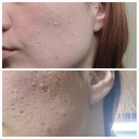 Image 3 of TCA 15% Chemical Skin Peel To Remove Acne And Fade Acne Marks