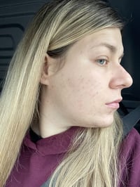 Image 4 of TCA 15% Chemical Skin Peel To Remove Acne And Fade Acne Marks