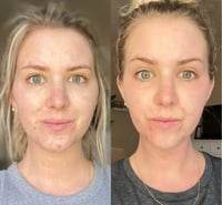 Image 2 of TCA 100% Chemical Skin Peel To Remove Acne And Fade Acne Marks