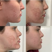 Image 3 of TCA 100% Chemical Skin Peel To Remove Acne And Fade Acne Marks