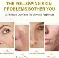 Image 4 of TCA 100% Chemical Skin Peel To Remove Acne And Fade Acne Marks