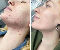 Image 2 of TCA 50% Chemical Skin Peel To Remove Acne And Fade Acne Marks