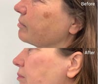 Image 3 of TCA 50% Chemical Skin Peel To Remove Acne And Fade Acne Marks