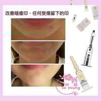 Image 3 of VOT 微晶海綿針👸🏻真人實測