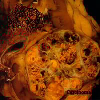 Blasted Pancreas - Carcinoma CD