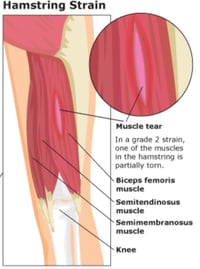 Image 4 of Achilles Tendon & Hamstring Acupuncture 