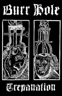 Image 2 of Burr Hole – Trepanation