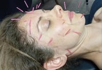 Image 2 of Cosmetic Acupuncture