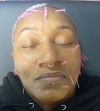 Image 3 of Cosmetic Acupuncture