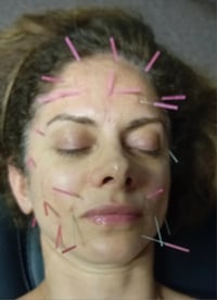 Image 4 of Cosmetic Acupuncture
