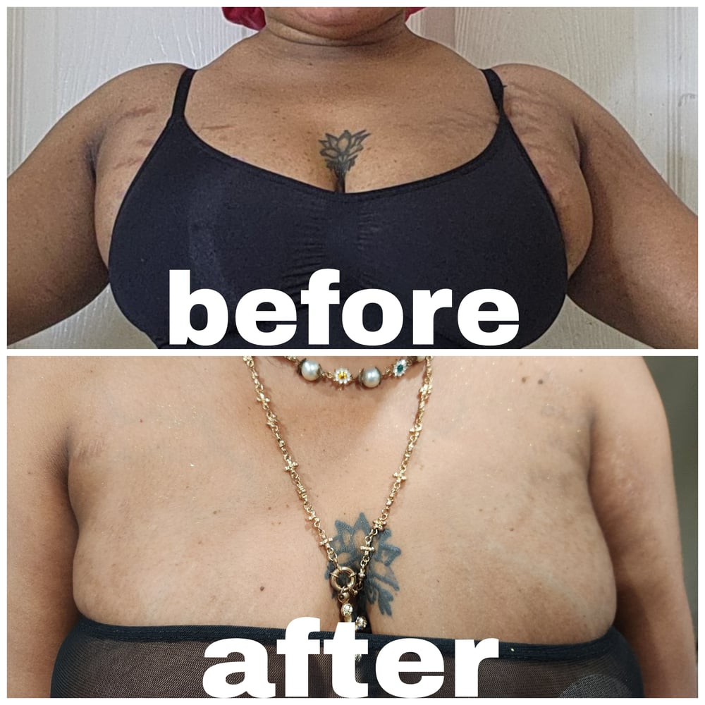 Image of Miraclebody Stretch Marks Remover cream, and soap