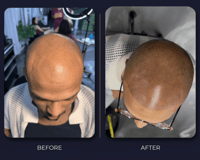 Full Head Scalp Micropigmentation (SMP) [Afterpay, Klarna, Affirm)