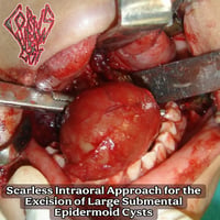 Corpus Luteum Cyst -  Scarless Intraoral Approach... Mini CDr