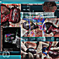 Purulent Rectal Mucus - Testicular Torsion After Laparoscopic Appendectomy CDr