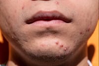Image 3 of “CLEAR SKIN” ECZEMA, PSORIASIS, ROSACEA, ACNE 
