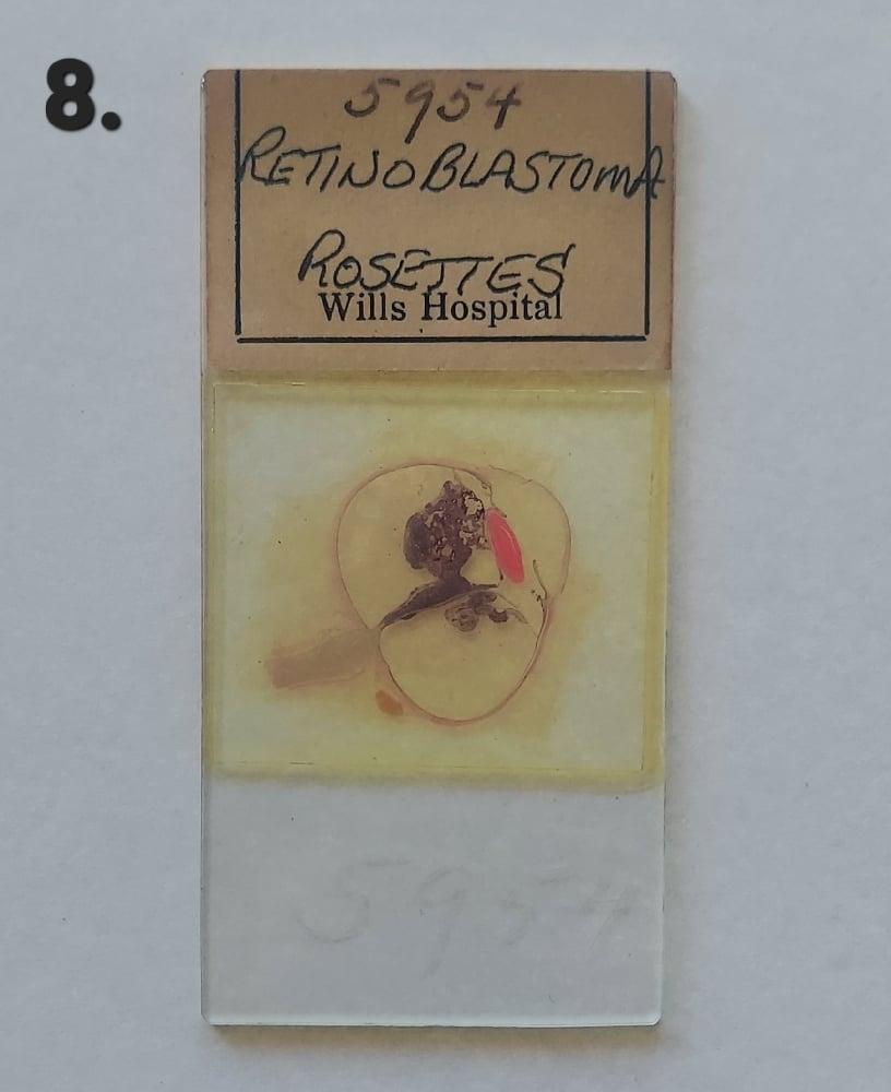 Vintage Medical Slides – Human Eye (Retinoblastimo)
