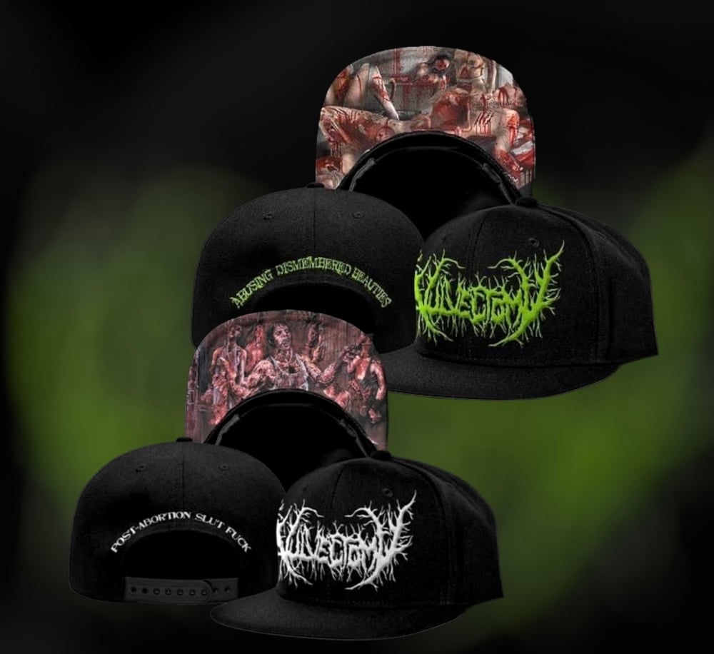 Vulvectomy (snapback)