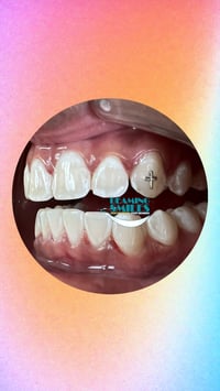 Image 5 of Teeth Whitening + Tooth Gems Specials