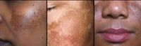 Image 8 of  “CLARITY” ACANTHOSIS NIGRICAN (MALASMA) CREAM  